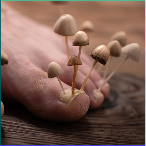Mycose des ongles : comment s'en débarrasser efficacement ?